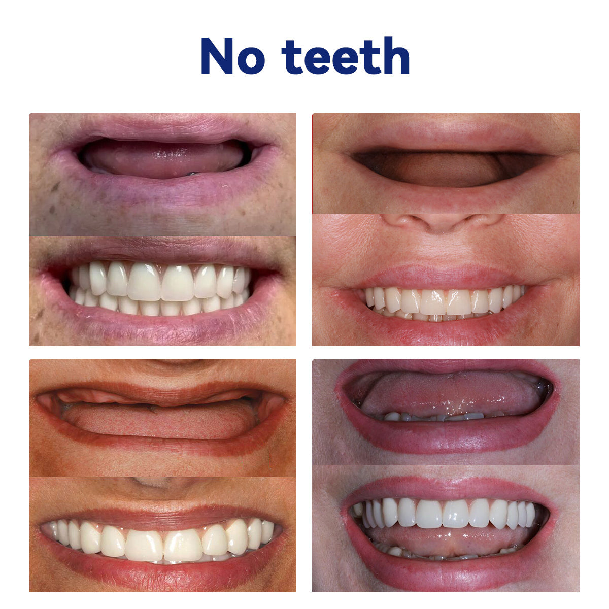𝐵𝑖𝑘𝑒𝑛𝑑𝑎® 𝑆𝑖𝑙𝑖𝑐𝑜𝑛𝑒 𝐷𝑒𝑛𝑡𝑢𝑟𝑒 𝑅𝑢𝑙𝑒𝑟 𝑆𝑒𝑡 (✅✅ Tested, Trusted, and Dentist-Recommended)🔥