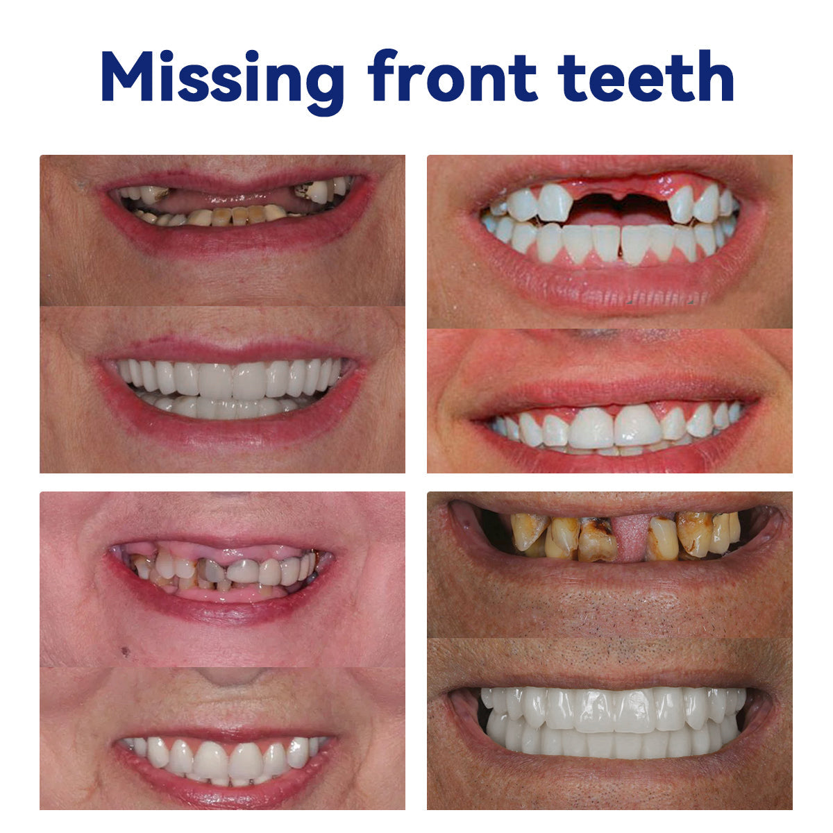 𝐵𝑖𝑘𝑒𝑛𝑑𝑎® 𝑆𝑖𝑙𝑖𝑐𝑜𝑛𝑒 𝐷𝑒𝑛𝑡𝑢𝑟𝑒 𝑅𝑢𝑙𝑒𝑟 𝑆𝑒𝑡 (✅✅ Tested, Trusted, and Dentist-Recommended)🔥