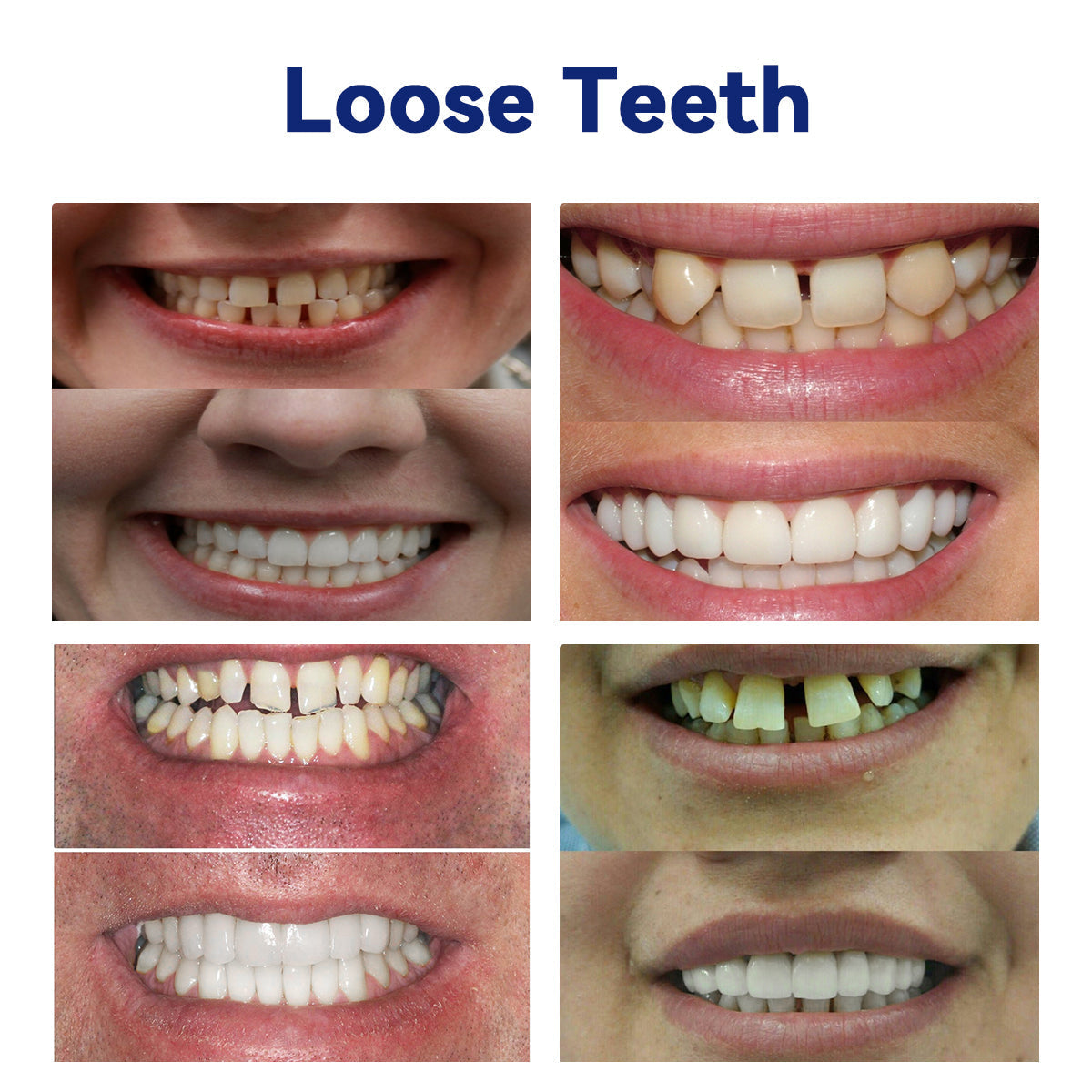 𝐵𝑖𝑘𝑒𝑛𝑑𝑎® 𝑆𝑖𝑙𝑖𝑐𝑜𝑛𝑒 𝐷𝑒𝑛𝑡𝑢𝑟𝑒 𝑅𝑢𝑙𝑒𝑟 𝑆𝑒𝑡 (✅✅ Tested, Trusted, and Dentist-Recommended)🔥