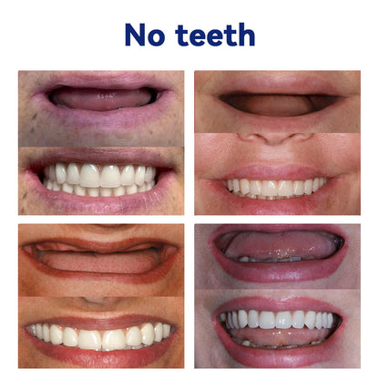 𝐵𝑖𝑘𝑒𝑛𝑑𝑎® 𝑆𝑖𝑙𝑖𝑐𝑜𝑛𝑒 𝐷𝑒𝑛𝑡𝑢𝑟𝑒 𝑅𝑢𝑙𝑒𝑟 𝑆𝑒𝑡 (✅✅✅ Tested, Trusted, and Dentist-Recommended）